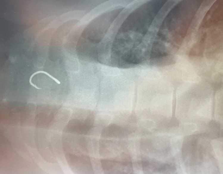 A radiograph (X-ray) image of a fishing hook lodged in a Hawaiian monk seal’s esophagus.